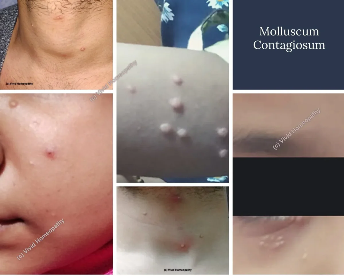 Molluscum Contagiosum – Understanding from Homeopathic Point of View